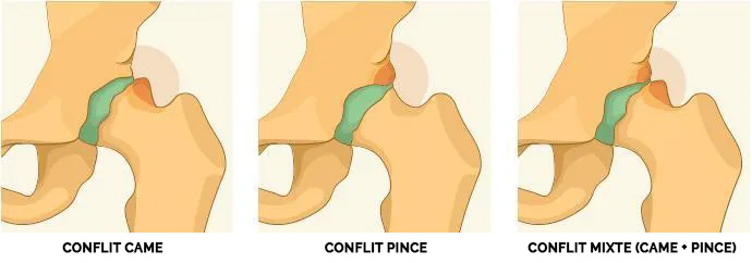 Arthroscopie de hanche