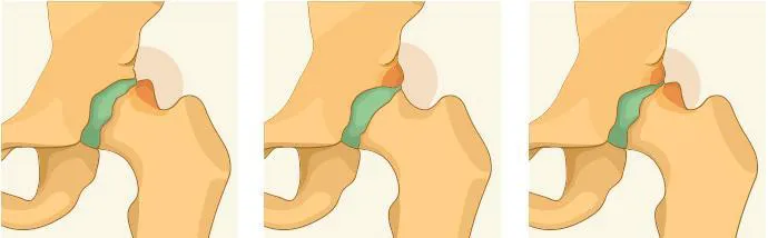 Arthroscopie de hanche