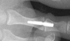 arthrodese-orteils