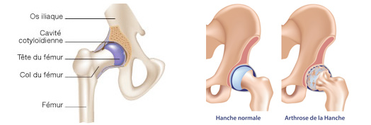 arthrose-hanche