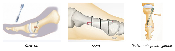 chevrons-scraf-osteotomie