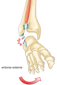 entorse-cheville