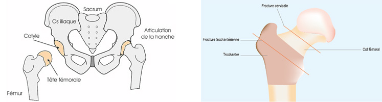 fracture-extremite-superieur-femur