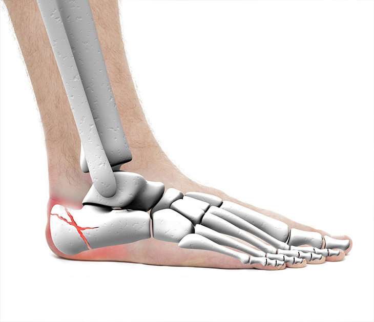 Fracture du Calcanéum