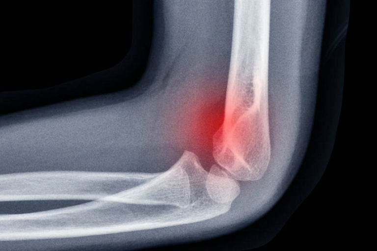Traumatologie spécialisée Fractures du coude