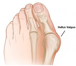 Hallux Valgus à Lyon - Chirurgie du pied - Oignon - Orthopédie