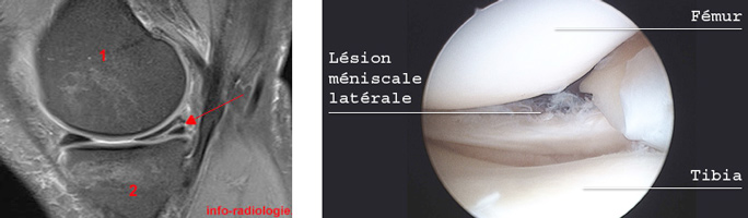 irm-lesions-meniscales