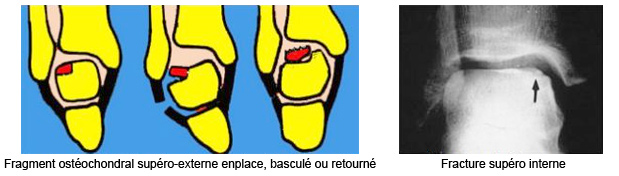 lesions-artoculaire-dome-astragalien