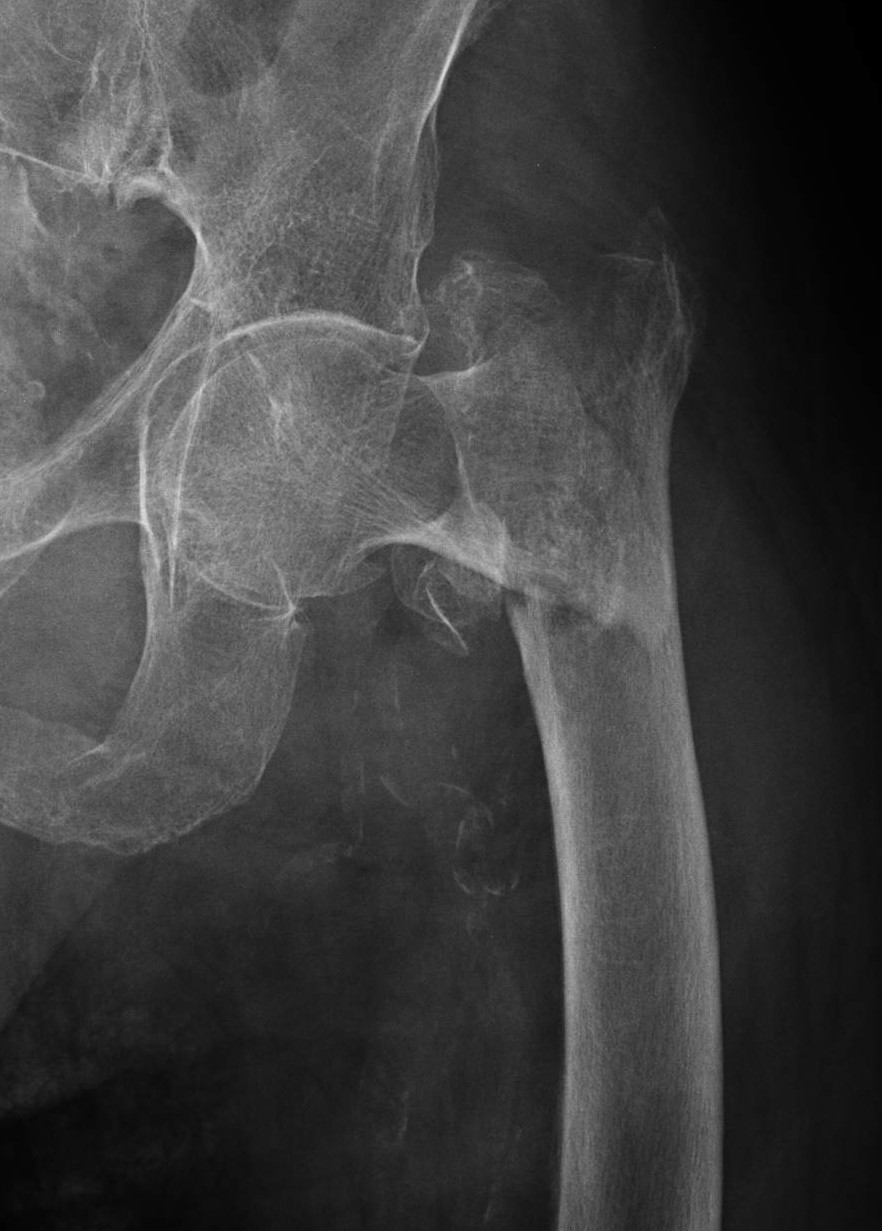Fracture du col du Fémur à Lyon - Chirurgie de la hanche