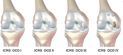 osteochondrite