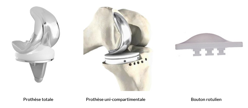 Arthrose du genou à Lyon - Chirurgie orthopédique - Prothèse