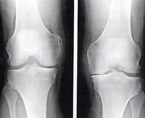 Arthrose du genou à Lyon - Chirurgie orthopédique - Prothèse