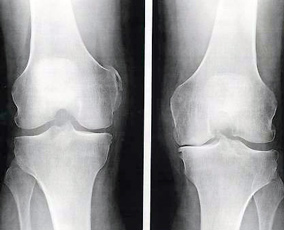 radiographie-arthrose-genou