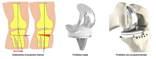 traitement-arthrose-genou